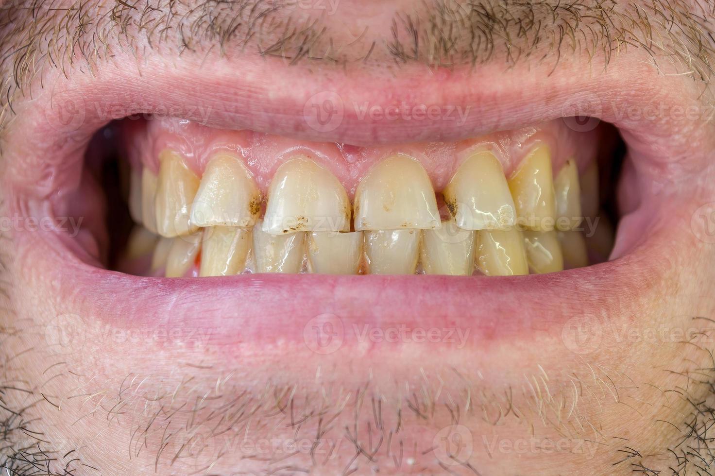 dents laides d'un homme, tordues et sales. dentisterie photo