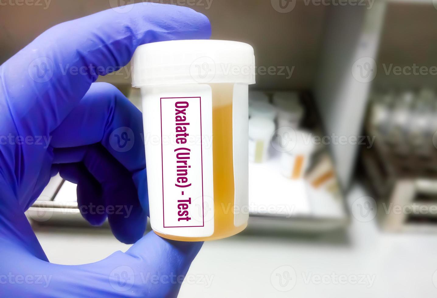 test d'oxalate d'urine pour diagnostiquer l'hyperoxalurie secondaire ou primaire, l'hyperoxalurie idiopathique ou un apport alimentaire excessif en oxalate ou en vitamine c. photo
