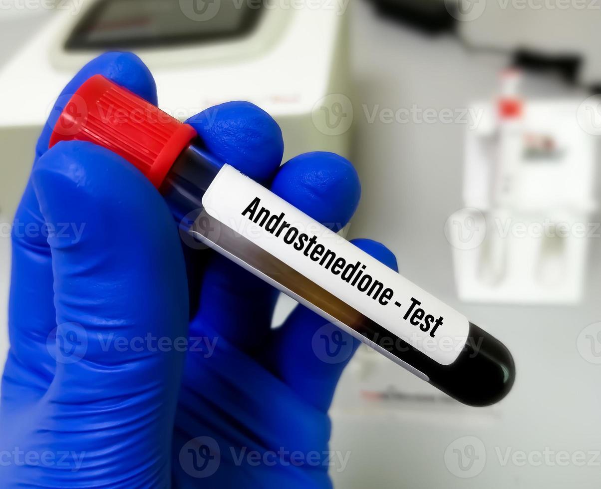 Le test d'androstènedione est utilisé pour évaluer la fonction de la glande surrénale et des ovaires ou des testicules. Hyperplasie surrénale congénitale. photo