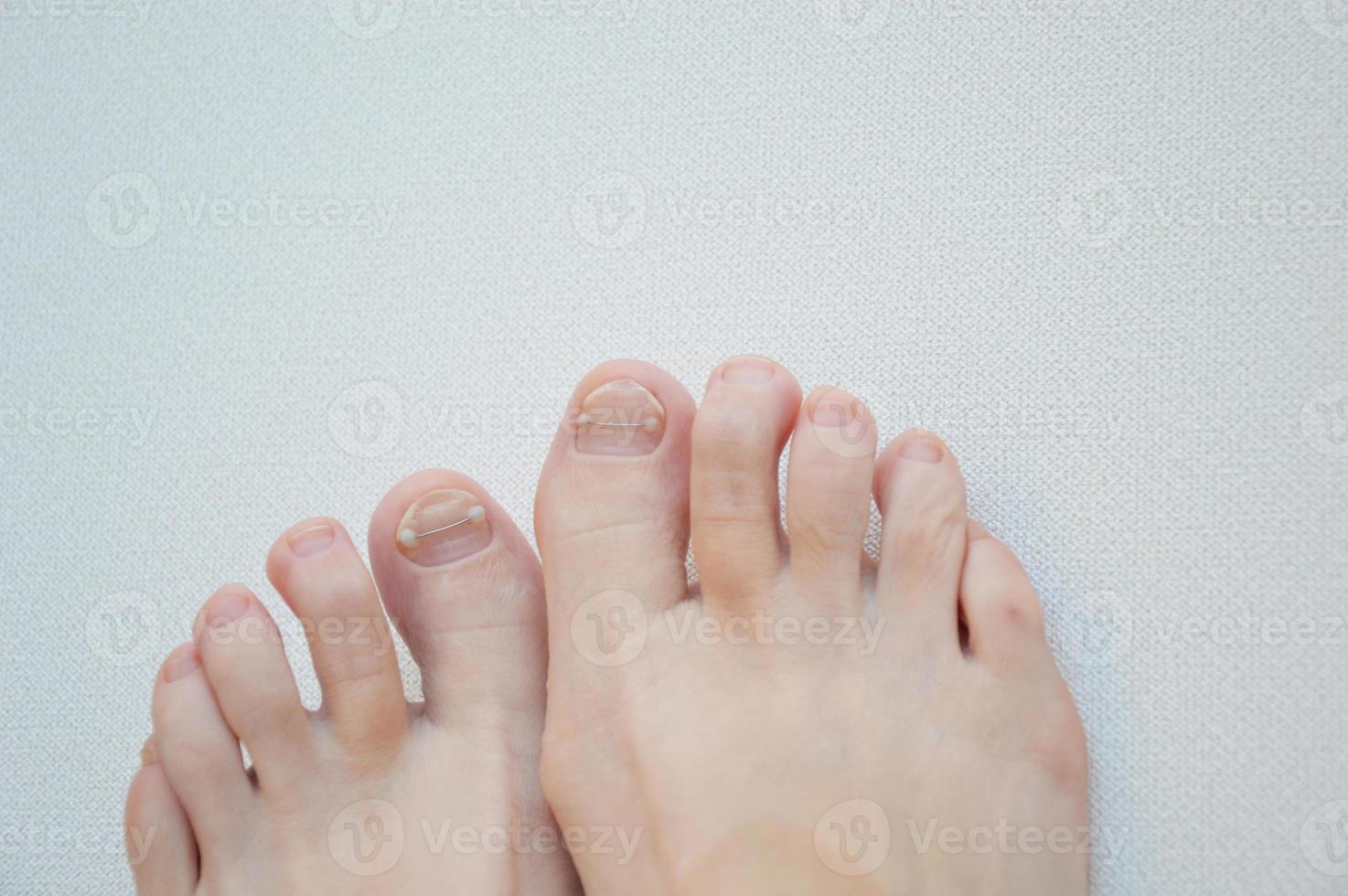 pédicure médicale matérielle. podologie. correction de la forme de l'ongle du pied, pose d'une agrafe en titane, fils. patient subissant un traitement de pédicure par un podiatre. photo