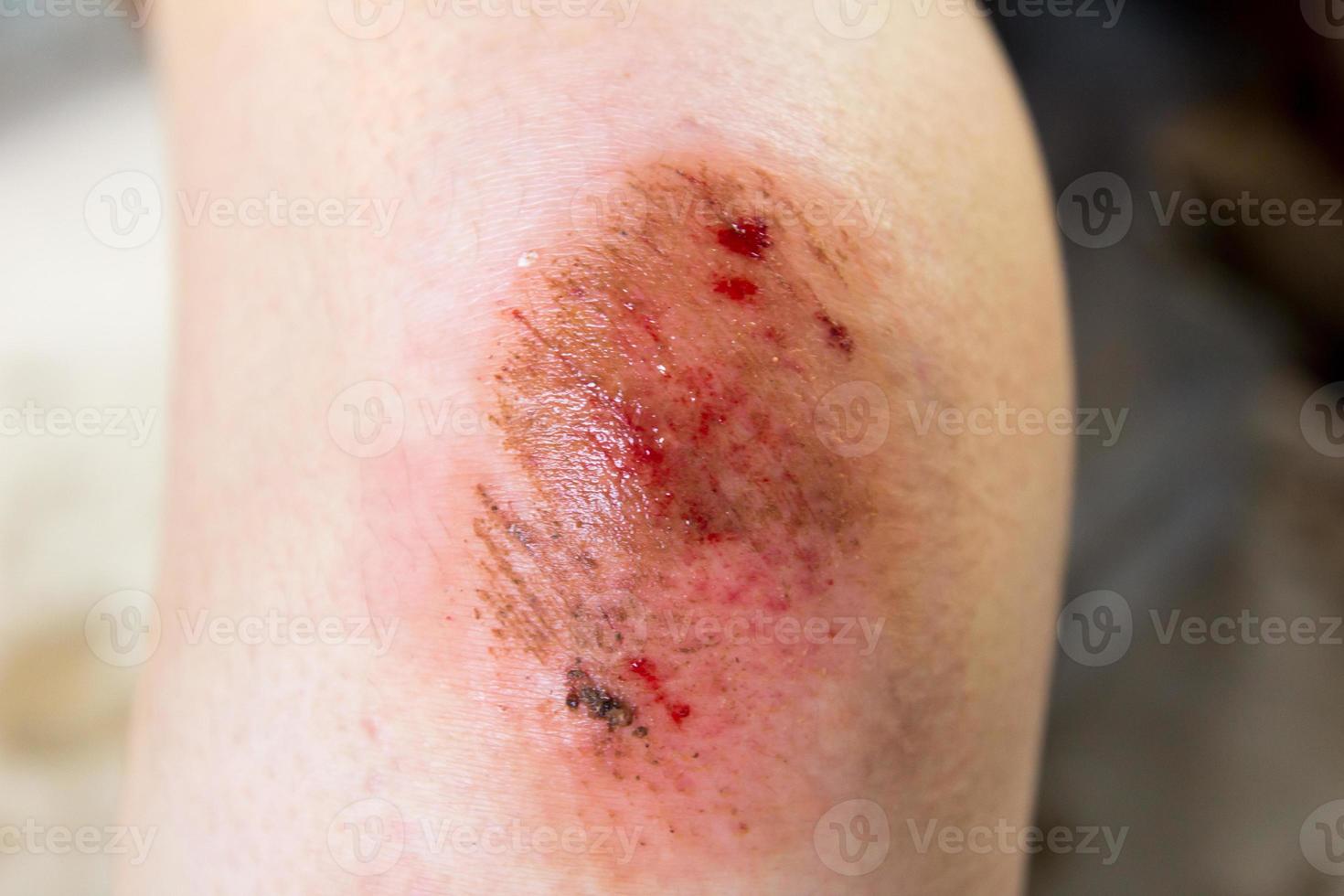 Blessure contusionnée sur fond de genou femme photo