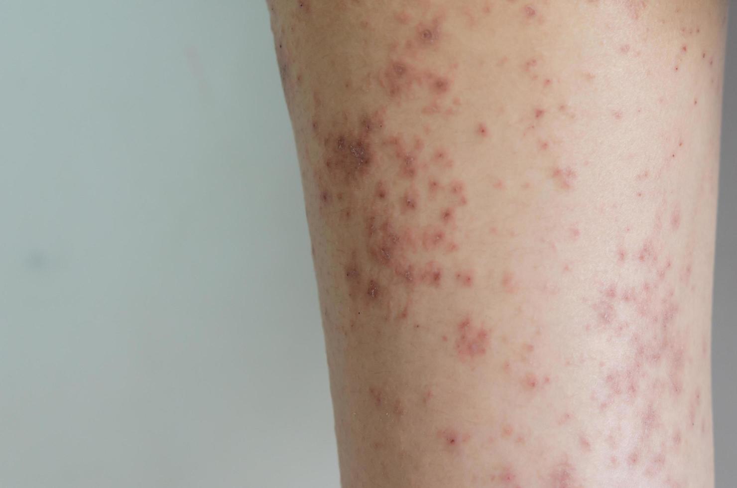 éruption cutanée rouge maladie de la peau de la fille causée par des allergies aux médicaments, à la nourriture, aux produits chimiques, à un système immunitaire défaillant dans la lymphe. photo