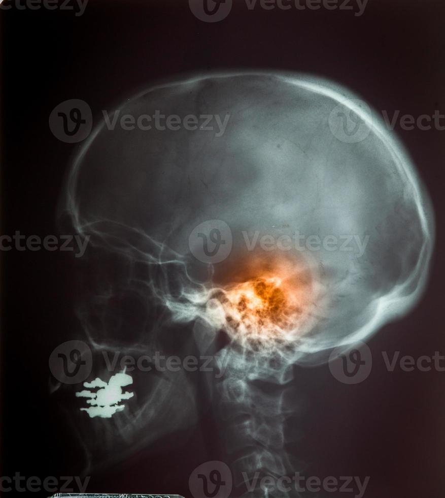 IRM des rayons X du col de la colonne vertébrale et du stress de la tête photo