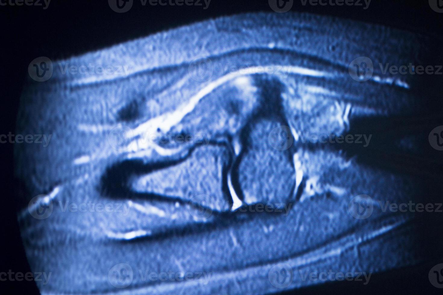 IRM imagerie par résonance magnétique balayage du bras du coude photo