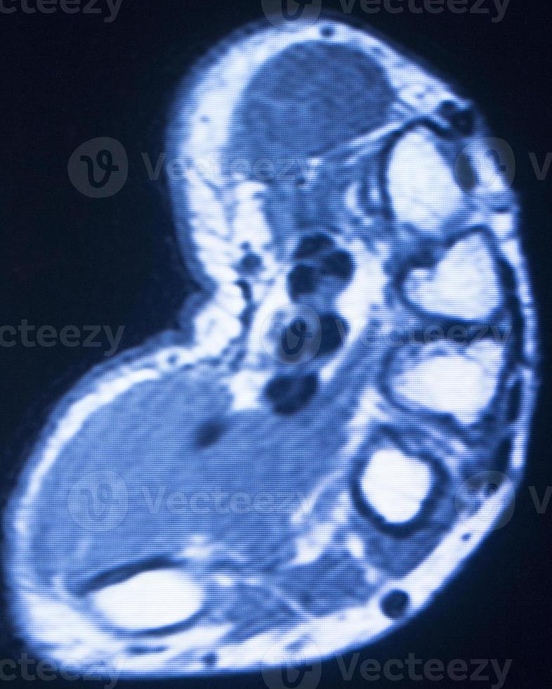 imagerie par résonance magnétique IRM balayage des doigts de la main photo