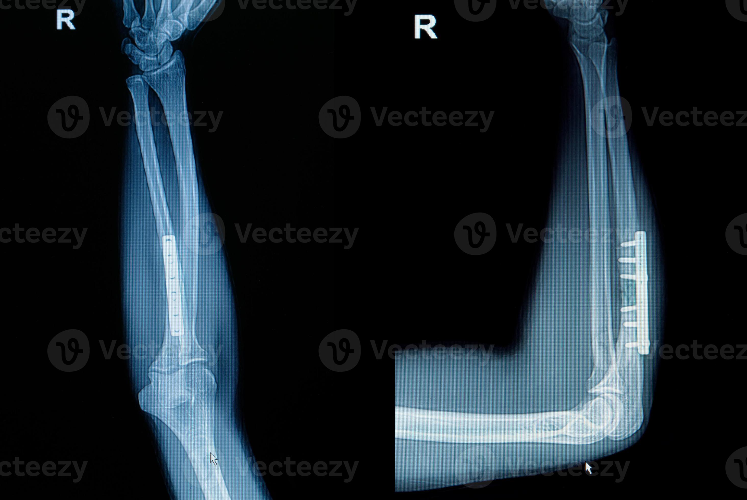 fracture du poignet par radiographie du film photo