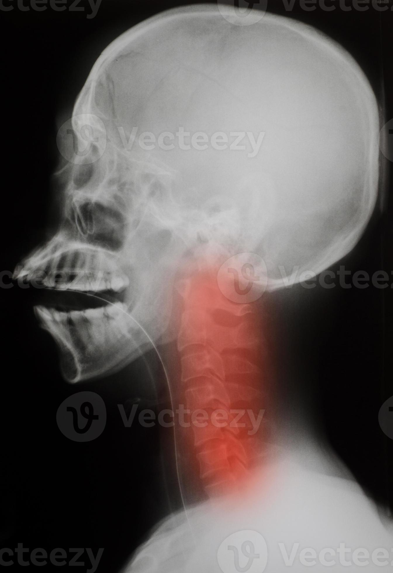 radiographie: crâne latéral - blessure au cou photo