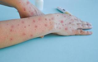 virus de la variole du singe, un nouveau problème mondial de l'humanité moderne. gros plan des mains d'une personne malade avec des boutons et des cloques. photo