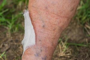 jambe blessée d'une femme âgée avec des varices. pansement sur la plaie photo