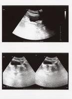 échographie complète de l'abdomen photo