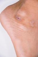 ulcère du pied rouge inflammation de la plaie fond blanc guérison concept photo