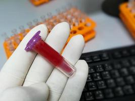 scientifique tenant eppendorf avec échantillon de sang hémolysé. l'échantillon d'hémolyse peut entraîner un faux rapport du patient. erreur pré-analytique. photo