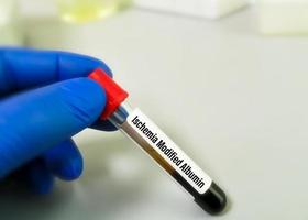 échantillon de sang pour le test d'albumine modifiée d'ischémie, un marqueur d'ischémie myocardique. intervention coronarienne percutanée. photo