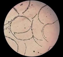 photomicrographie montrant des hyphes de dermatophytes, raclage des ongles pour test de champignon photo