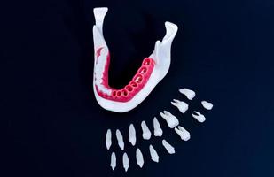 processus d'installation d'implants dentaires et de couronnes photo