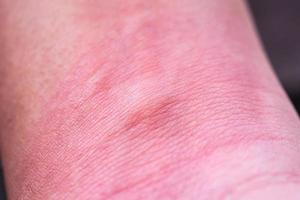 allergie cutanée avec éruption après piqûre de moustique photo