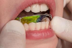l'orthodontiste met une plaque sur les dents inférieures, une visite chez l'orthodontiste. photo