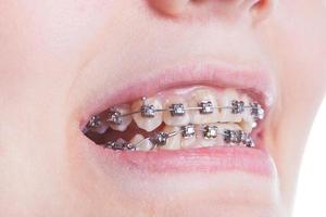 appareil orthodontique sur les dents en gros plan photo