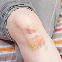 traumatisme du genou - ecchymose sur la jambe photo