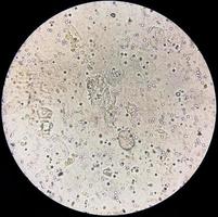 image microscopique montrant des cristaux d'oxalate de calcium et d'autres cristaux urinaires provenant de sédiments urinaires. photo