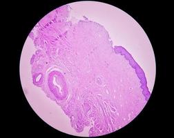 examen histologique d'une biopsie utérine évocatrice d'un prolapsus utérin. cervicite chronique avec prolapsus. photo