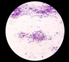 vue microscopique du frottis de Pap montrant un négatif sévère pour la malignité de la lésion intraépithéliale ou nilm. diagnostic du cancer du col de l'utérus. photo