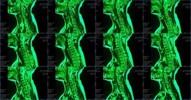 ensemble de 6 IRM sagittales de couleur verte de la région du cou d'un homme caucasien de 34 ans présentant une extrusion paramédiale bilatérale du segment c6-c7 photo