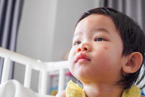 jolie petite fille asiatique avec une allergie au visage de tache rouge causée par une piqûre d'insecte photo