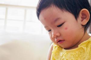 jolie petite fille asiatique avec une allergie au visage de tache rouge causée par une piqûre d'insecte photo