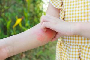 petite fille a une allergie cutanée et des démangeaisons sur son bras photo