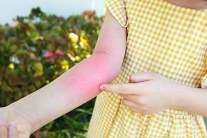 petite fille a une allergie cutanée et des démangeaisons sur son bras photo