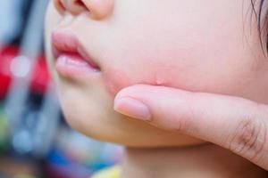 mère appliquant une crème antihistaminique topique sur le visage de l'enfant avec une éruption cutanée et une allergie avec une tache rouge causée par une piqûre de moustique photo