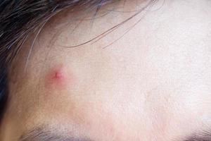 acné inflammatoire avec tache rouge sur le visage gros plan photo