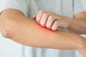 jeune homme asiatique qui démange et se gratte le bras à cause de la dermatite de l'eczéma de la peau sèche qui démange photo