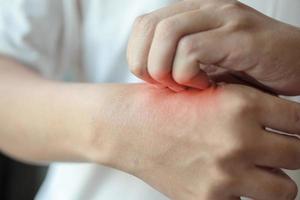 homme qui démange et se gratte la main à cause d'une piqûre d'insecte ou d'une dermatite d'eczéma de la peau sèche qui démange photo