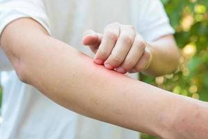 homme qui démange et se gratte le bras à cause d'une éruption cutanée allergique causée par une piqûre d'insecte en plein air photo