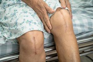Une patiente asiatique âgée ou âgée montre ses cicatrices Chirurgie de remplacement total de l'articulation du genou Chirurgie des plaies arthroplastie sur lit dans la salle d'hôpital de soins infirmiers, concept médical solide et sain. photo
