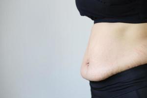 les femmes enceintes entraînant une graisse et une cicatrice de la peau du ventre rayée photo