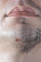 une coupure sur le menton d'un homme à cause d'un rasage bâclé. photo