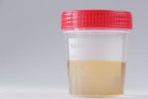 récipient en plastique avec analyse d'urine jaune pour détecter les maladies. photo