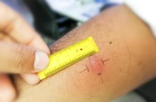 vaccination mantoux, photographie en gros plan du bras du patient avec une réaction de point rouge à la réalisation d'un test mantoux. patient tuberculeux positif. photo