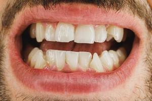 gros plan sur les dents d'un jeune homme lors de la préparation d'un orthodontiste photo