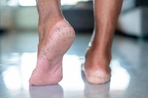 pieds fissurés, peau sèche, gros plan d'une femme âgée d'asie pieds fissurés, les talons d'une femme senoir asiatique qui passe de la marche au poids des pieds peut être traitée avec des exercices de perte de poids photo