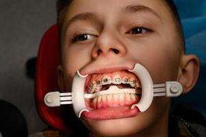 visite chez l'orthodontiste, pose d'appareils dentaires sur les dents du haut, écarteur blanc sur les lèvres de l'enfant. photo