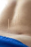 un homme est traité par acupuncture sur le dos. la procédure d'acupuncture. traitement du dos photo