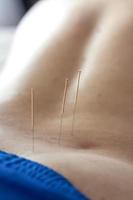 un homme est traité par acupuncture sur le dos. la procédure d'acupuncture. traitement du dos photo