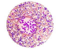 frottis sanguin sous microscopie montrant une leucémie lymphoblastique chronique ou une cll photo