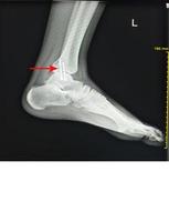 pied de radiographie après l'opération fixer les vis dans le tibia de la malléole médiale. photo