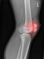 un film radiographique de la vue latérale du genou gauche montre une fracture de l'os rotulien de la rotule photo