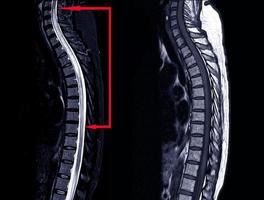 histoire d'IRM de la colonne thoracique d'une femme de 53 ans, présentant une parésie et une paresthésie des deux jambes. hypersignal longitudinalement étendu t2w au niveau de la moelle épinière . photo